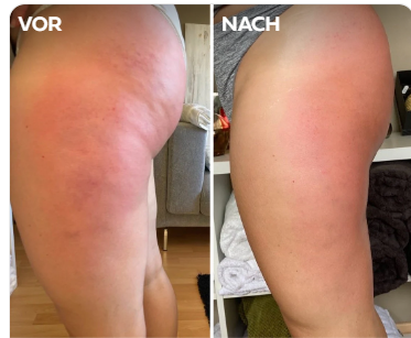 Velina BodySculpt™